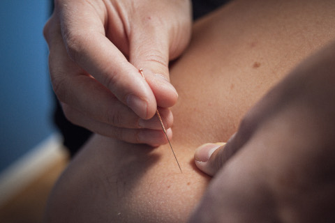 Behandling-med-dry-needling-ribekiropraktik.dk